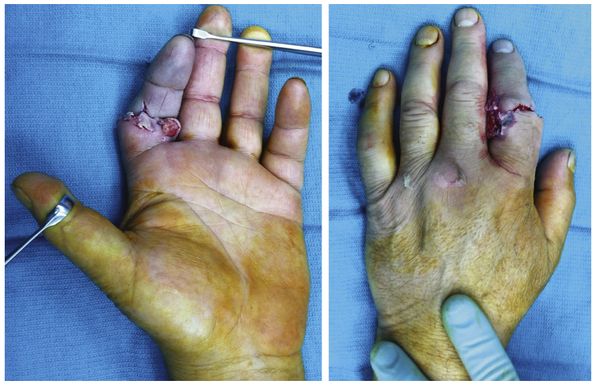 Открытый перелом пальца руки [6]