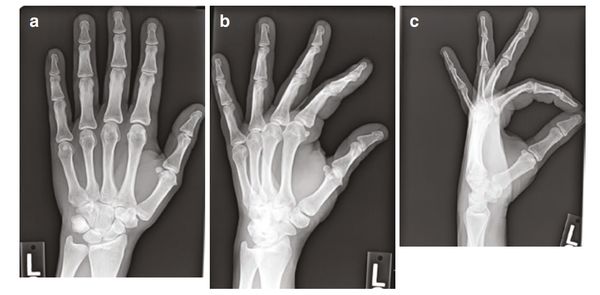 Рентген кисти в заднепередней, косой и боковой проекциях [8]