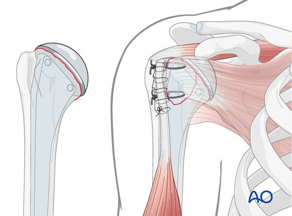 Гемиартропластика плечевой кости