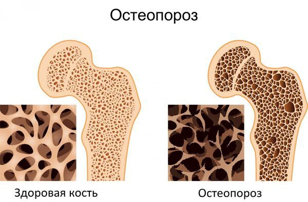 Остеопороз
