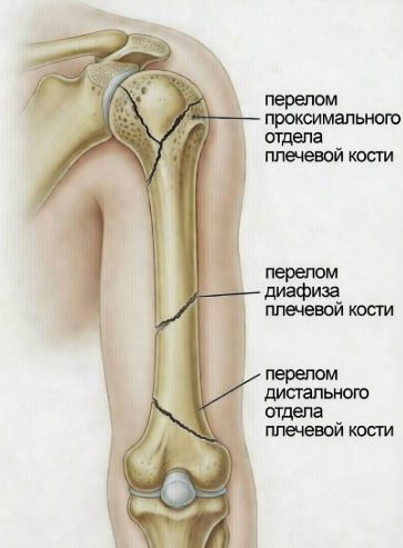 Виды переломов плеча