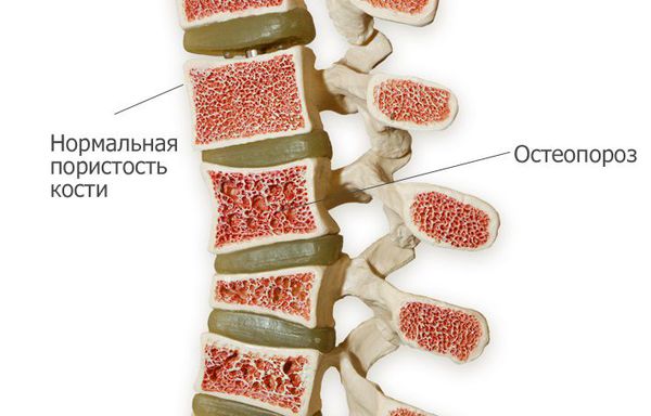 Кости позвоночника в норме и при остеопорозе