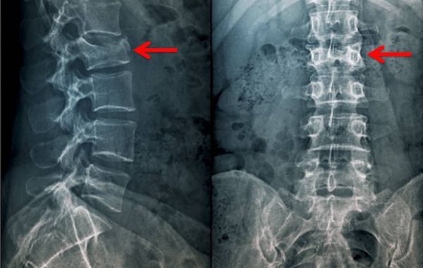 Перелом позвоночника на рентгене