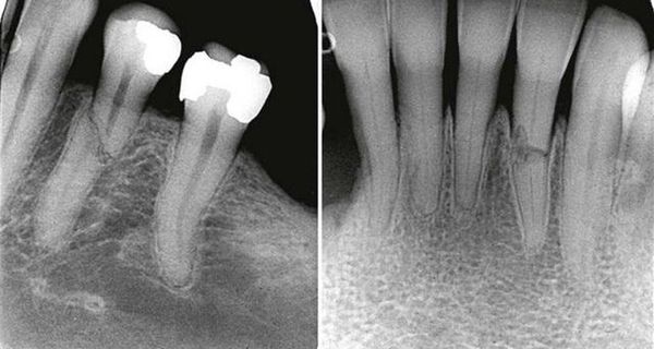 Перелом зуба на рентгенограмме