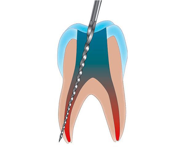 Перфорация стенки корня зуба