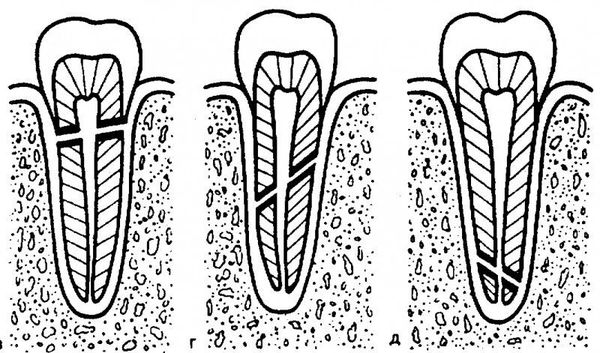 Виды переломов корня зуба