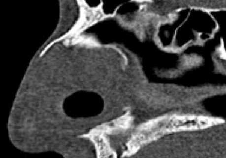 Перфорация перегородки носа на КТ [22]