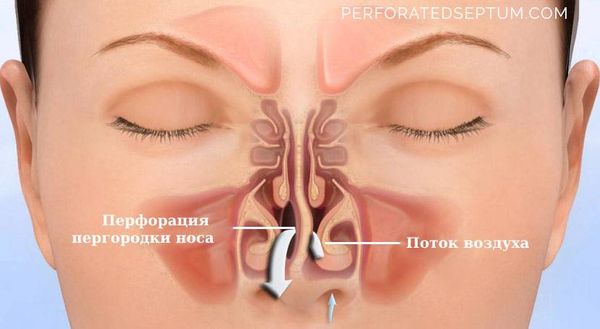 Перфорация носовой перегородки: что это за проблема и как её лечить?