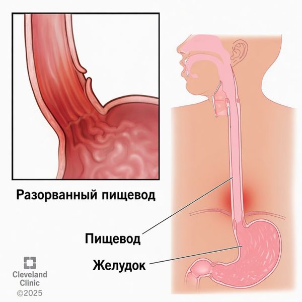 Перфорация пищевода