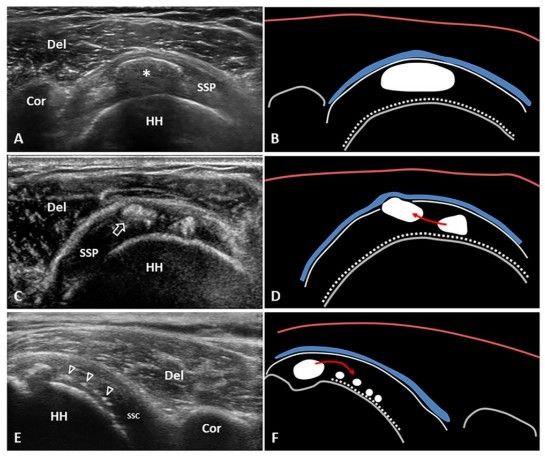 Кальцификаты на УЗИ [15]
