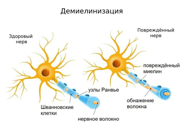 Демиелинизация