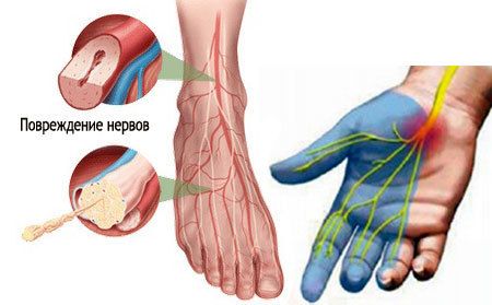 Повреждение нервов при периферической полинейропатии