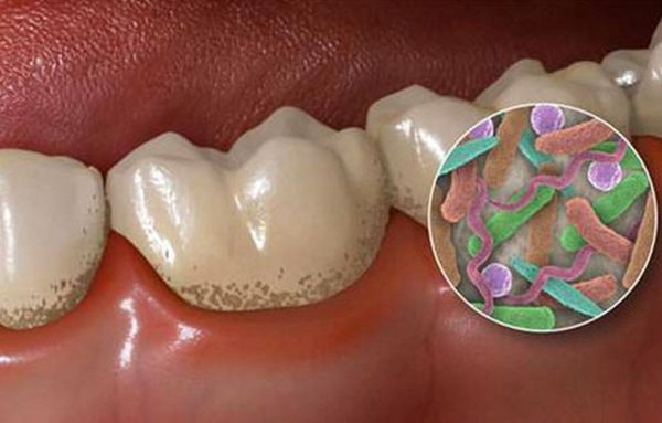 Бактериальная плёнка на поверхности зубов