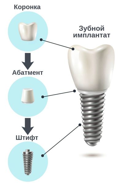 Строение зубного имплантата