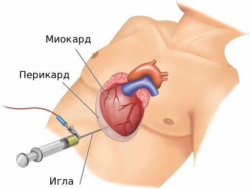 Дренирование перикарда