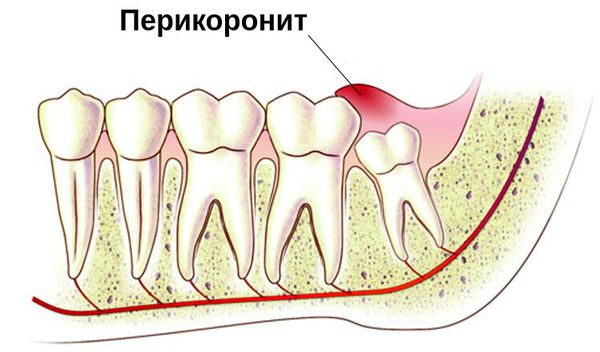 воспалился капюшон у зуба мудрости чем лечить. Смотреть фото воспалился капюшон у зуба мудрости чем лечить. Смотреть картинку воспалился капюшон у зуба мудрости чем лечить. Картинка про воспалился капюшон у зуба мудрости чем лечить. Фото воспалился капюшон у зуба мудрости чем лечить