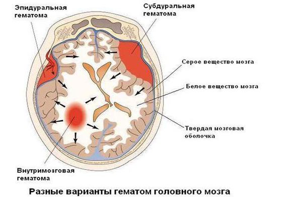 gematomy golovnogo mozga s