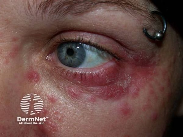 Периорбитальный дерматит [11]
