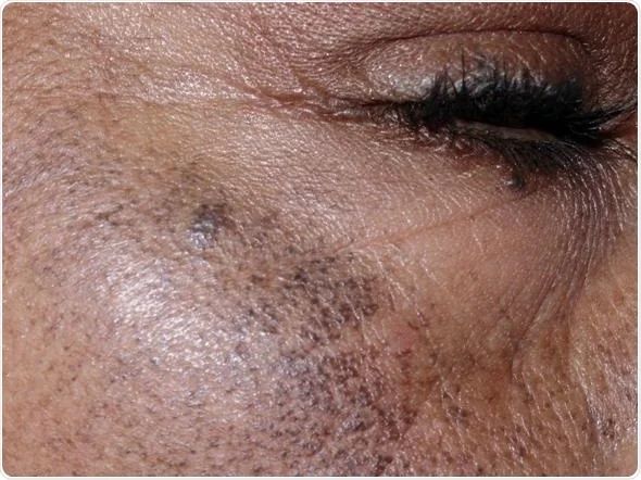 Экзогенный охроноз [14]