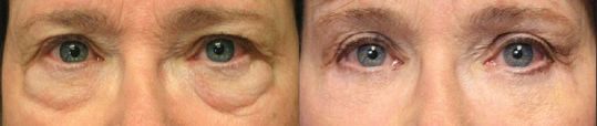 Лечение тёмных кругов  с помощью блефаропластики нижних век с пересадкой жировой ткани в нижнюю часть глазницы (до и после) [4]