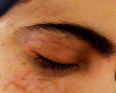 Невус Ота [13]