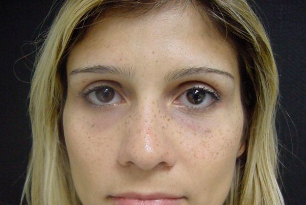 Периорбитальная гиперпигментация [2]