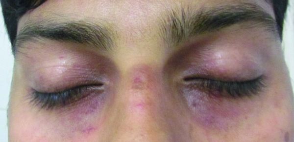 Периорбитальная гиперпигментация из-за воспаления [1]