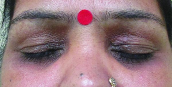 ПОГ из-за деформации носослёзной борозды [1]