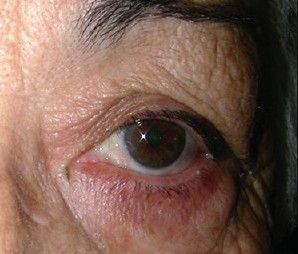 Тёмные круги под глазами из-за гиперемии (притока крови) и отложения гемосидерина [4]