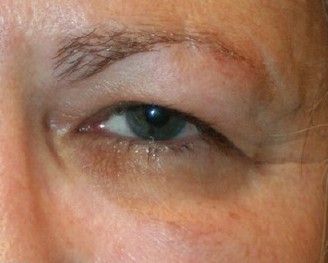 Тёмные круги под глазами из-за отложения пигмента [4]