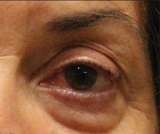 Тёмные круги под глазами из-за теней [4]