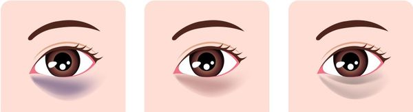 Тёмные круги под глазами могут отличаться по цвету в зависимости от механизма развития