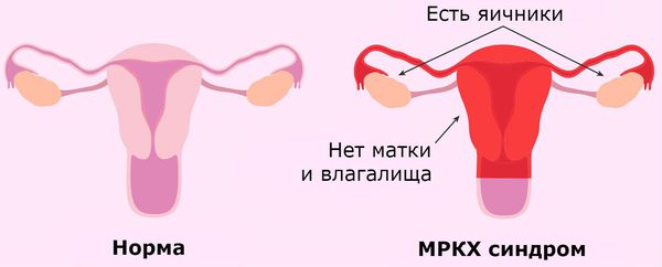 Женские половые органы в норме и при синдроме Майера — Рокитанского — Кустера — Хаузера Женские половые органы в норме и при синдроме Майера — Рокитанского — Кустера — Хаузера