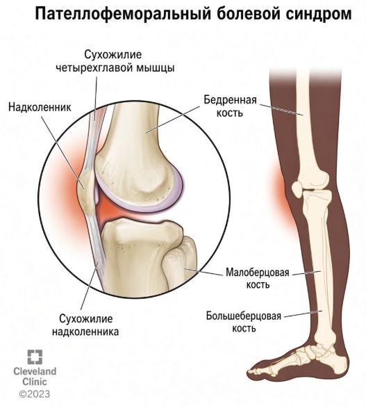 Пателлофеморальный болевой синдром Пателлофеморальный болевой синдром