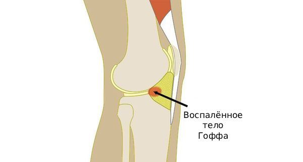 Воспалённое тело Гоффа Воспалённое тело Гоффа