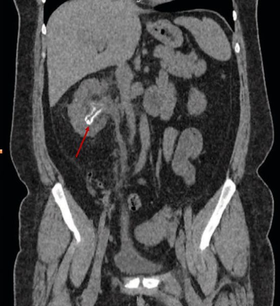 Инкрустирующий пиелит [1]