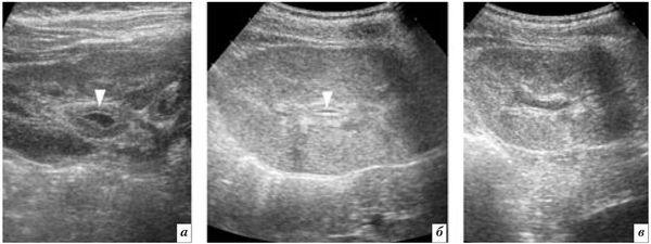 Как выглядит пиелит на УЗИ [8]