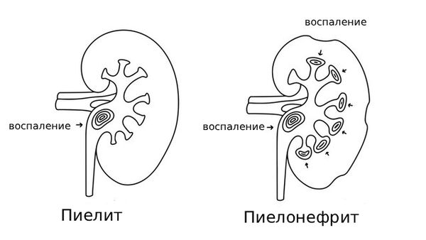 Разница между пиелитом и пиелонефритом