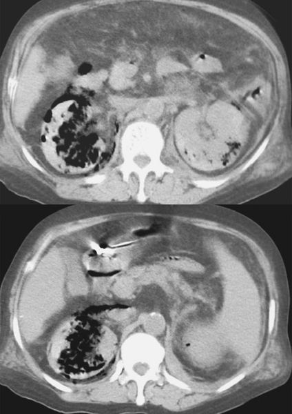 Скопление газа в паренхиме почки [24]