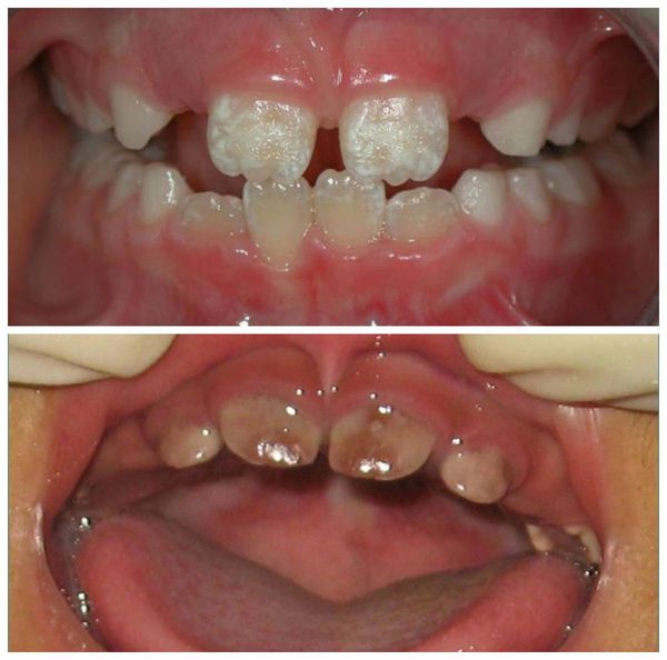 pigmentaciya molochnyh zubov s