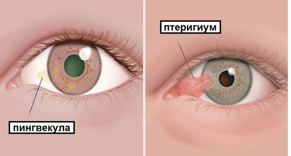 Пингвекула и птеригиум