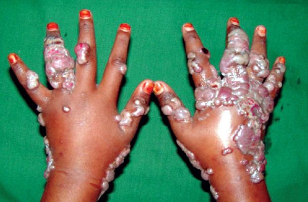 Бластомикозоподобная пиодермия [22]