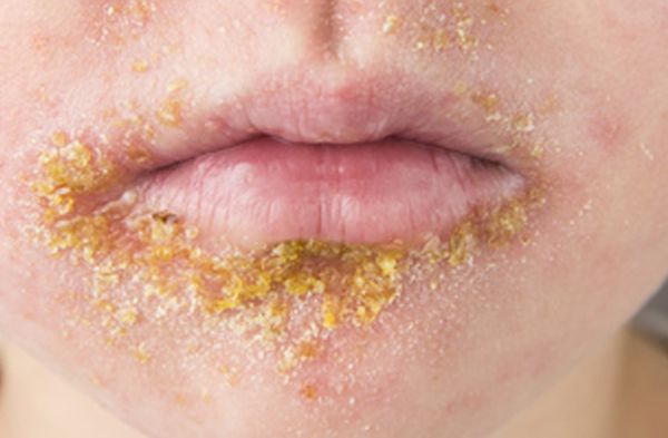 Импетиго стрептококковое [19]