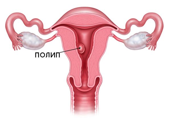 Полипы в матке