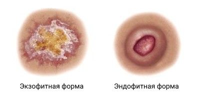 Экзофитная и эндофитная формы рака