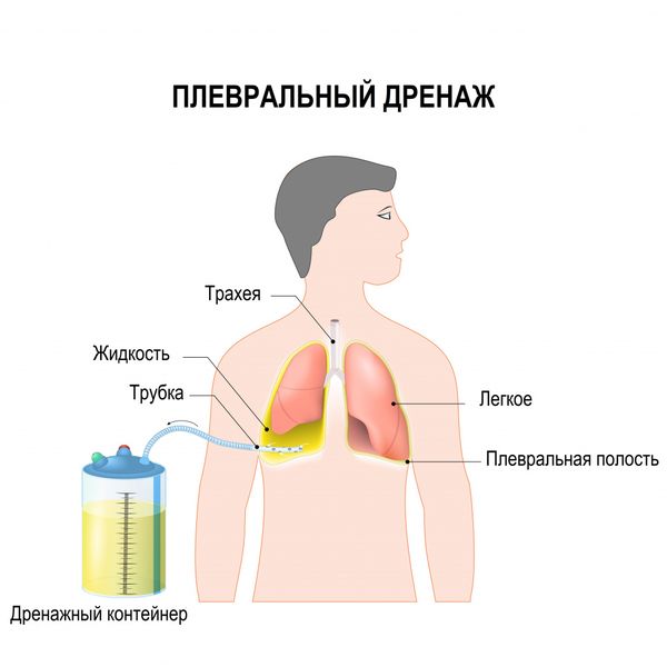 Дренаж плевры