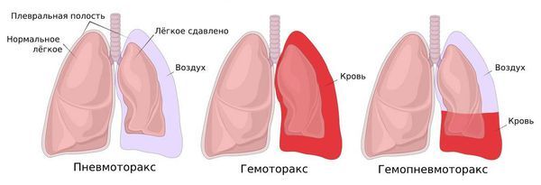 Осложнения пневмоторакса