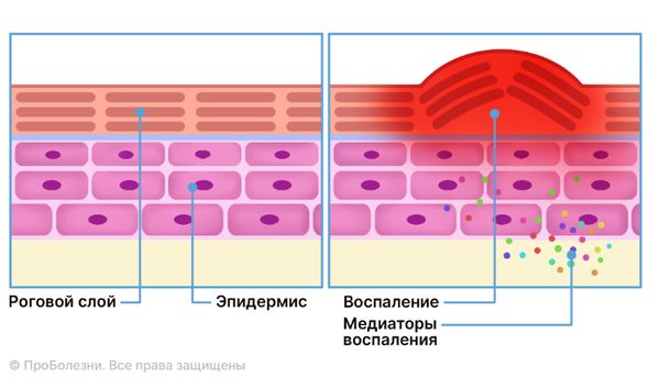 Механизм воспаления кожи