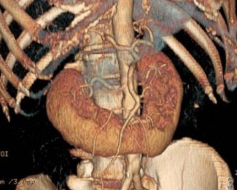 Трёхмерная модель подковообразной почки, построенная по данным компьютерной томографии [38]