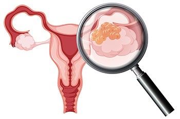 Пограничная опухоль яичника